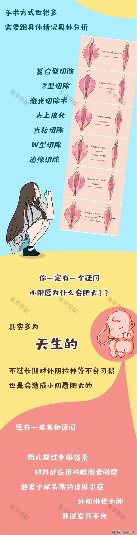 女性户型|女人二十种外阴照片：女人外阴的形状照片与生理知识…